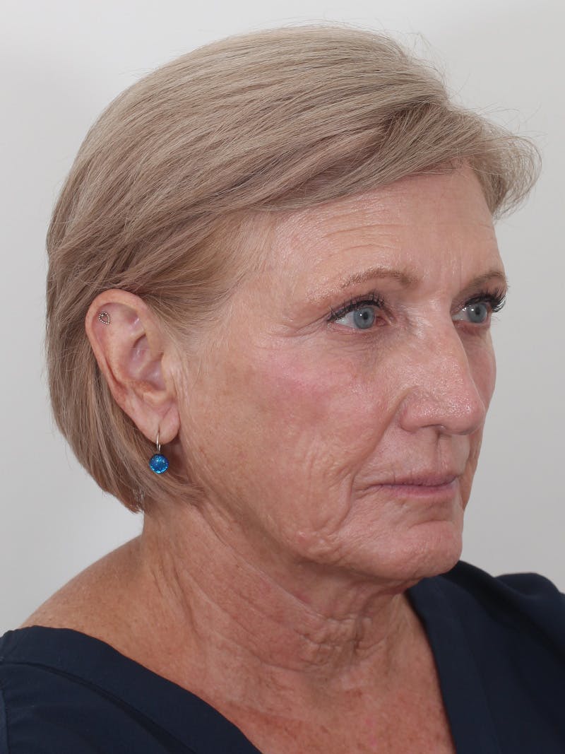 Brow Lift Before & After Gallery - Patient 395143 - Image 3