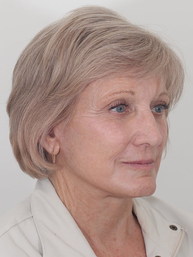 Brow Lift Before & After Gallery - Patient 395143 - Image 4