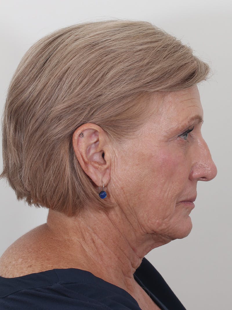 Brow Lift Before & After Gallery - Patient 395143 - Image 5
