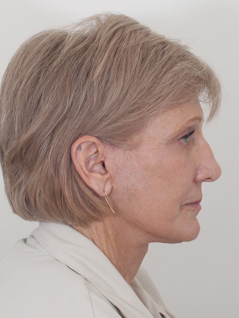 Brow Lift Before & After Gallery - Patient 395143 - Image 6