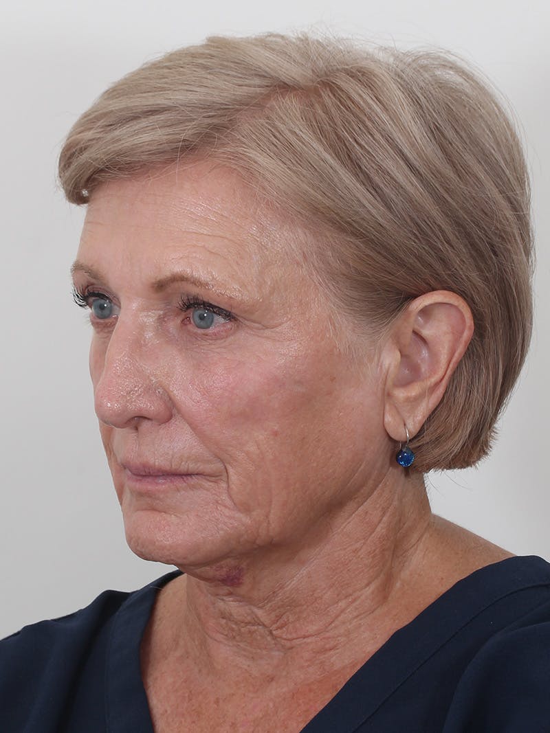 Brow Lift Before & After Gallery - Patient 395143 - Image 7