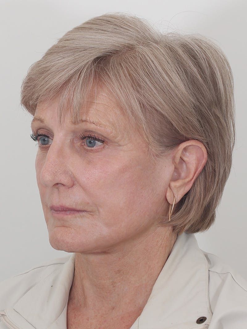 Brow Lift Before & After Gallery - Patient 395143 - Image 8