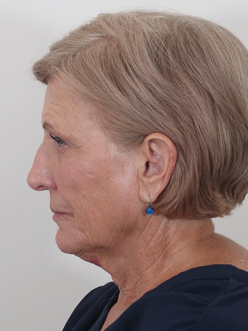 Brow Lift Before & After Gallery - Patient 395143 - Image 9
