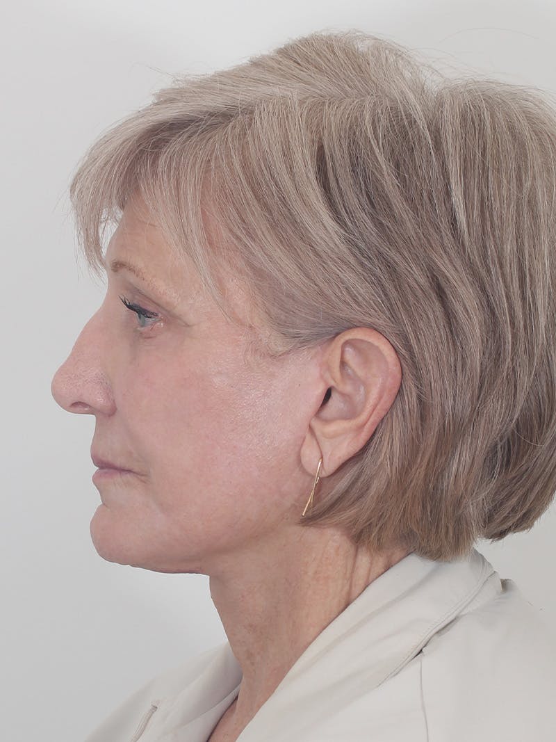 Brow Lift Before & After Gallery - Patient 395143 - Image 10