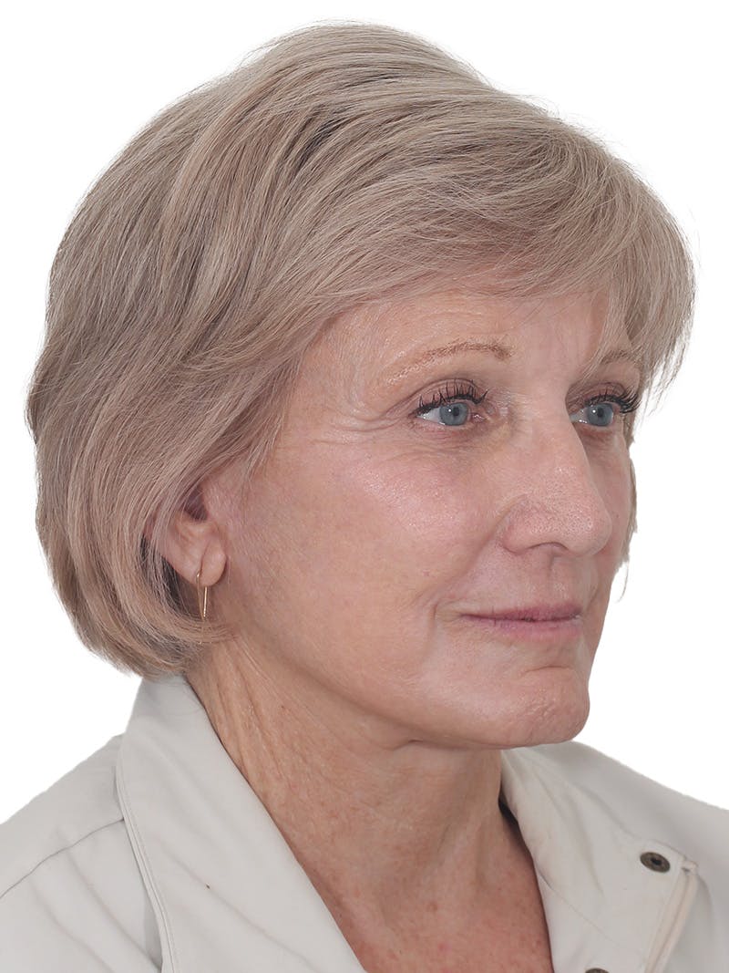 Facelift/Neck Lift Before & After Gallery - Patient 938006 - Image 4