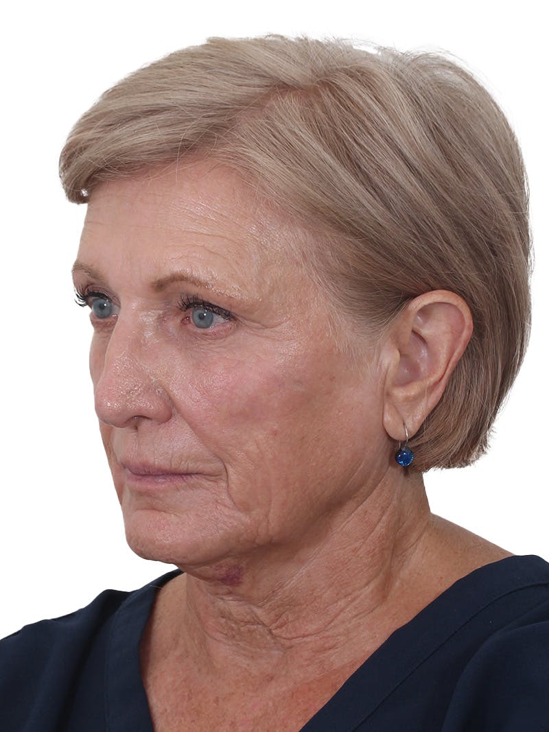 Facelift/Neck Lift Before & After Gallery - Patient 938006 - Image 7