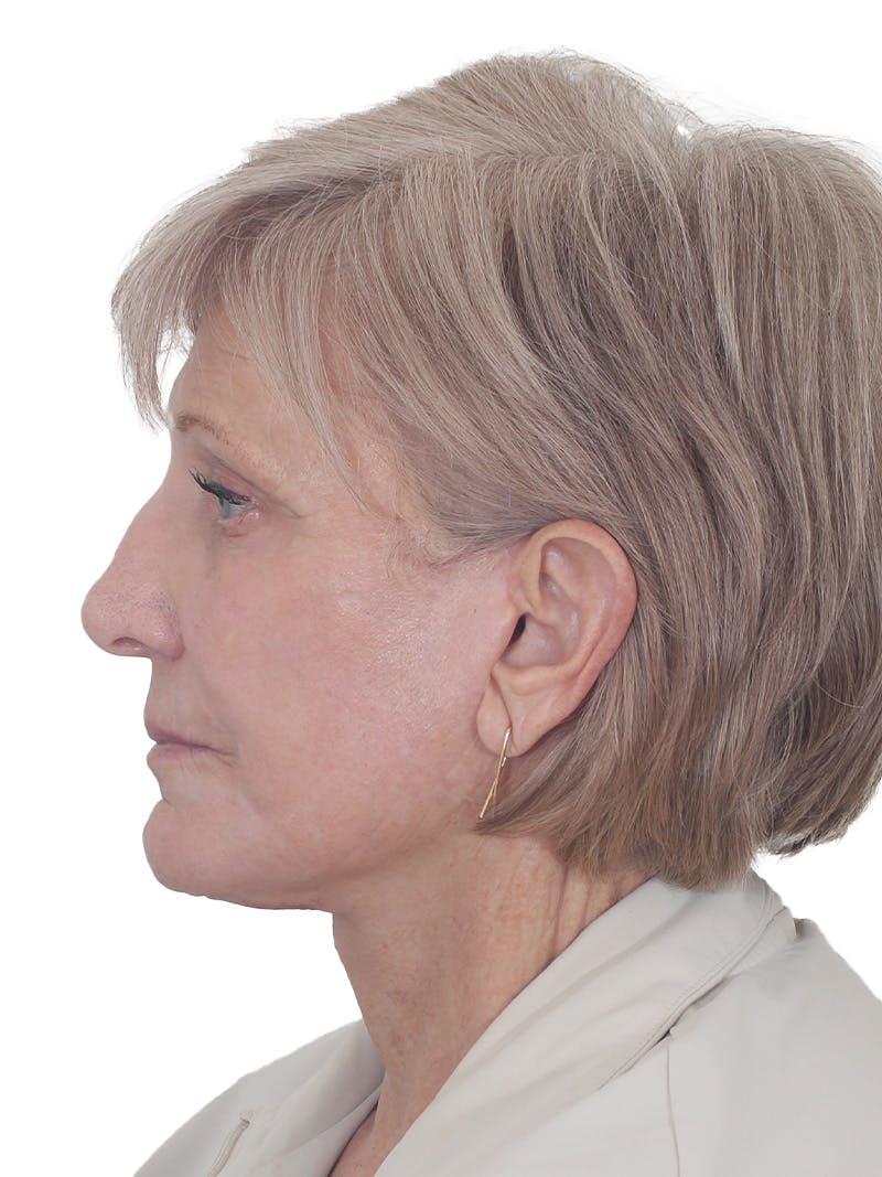 Facelift/Neck Lift Before & After Gallery - Patient 938006 - Image 10