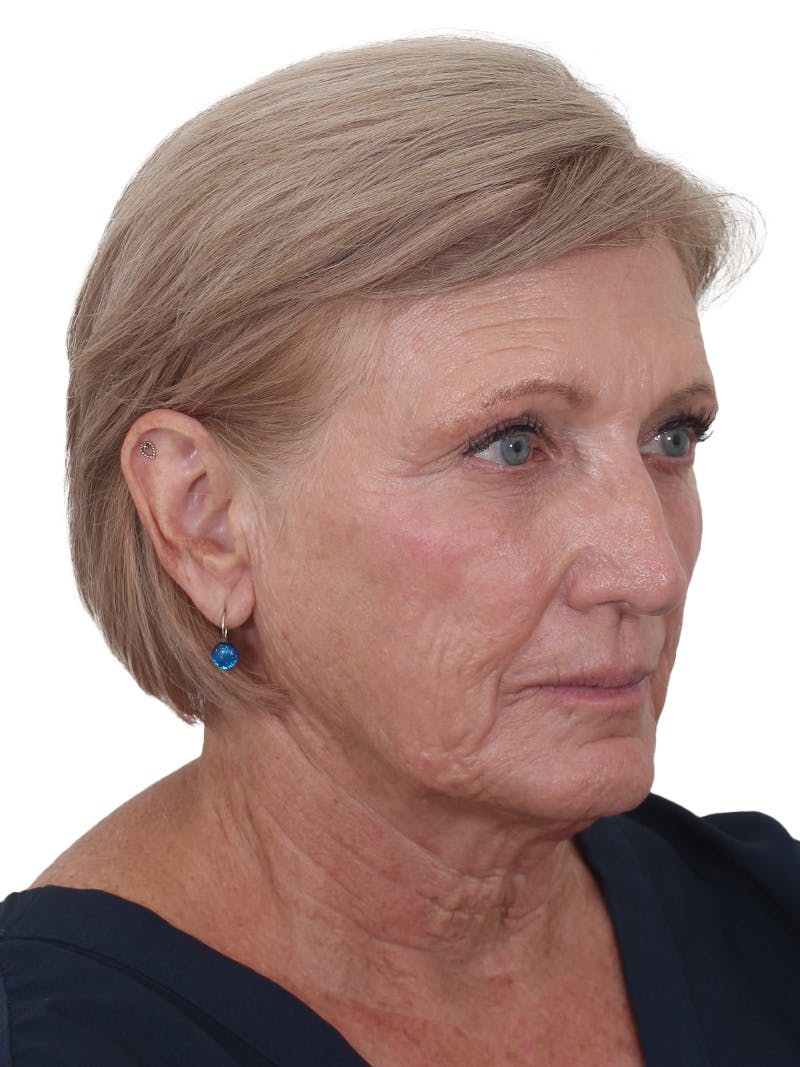 Fat Transfer Before & After Gallery - Patient 321539 - Image 3