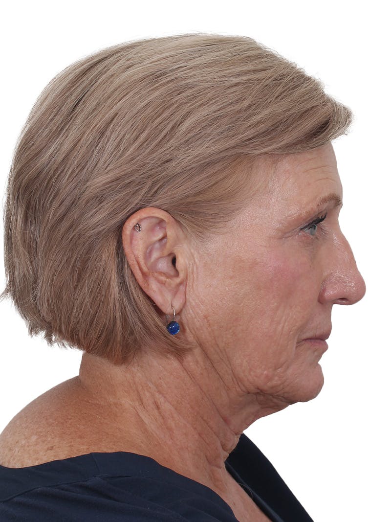 Fat Transfer Before & After Gallery - Patient 321539 - Image 5