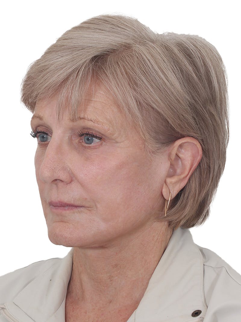 Fat Transfer Before & After Gallery - Patient 321539 - Image 8