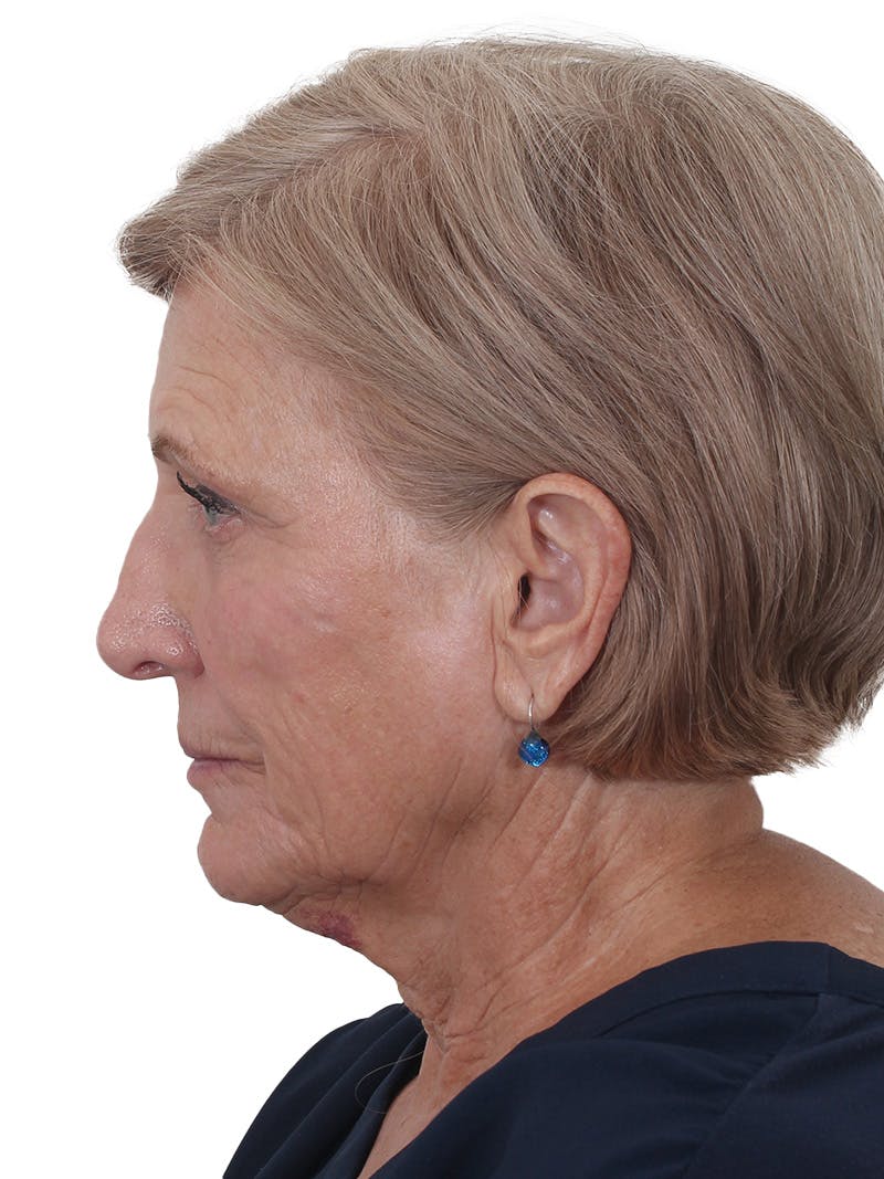 Fat Transfer Before & After Gallery - Patient 321539 - Image 9