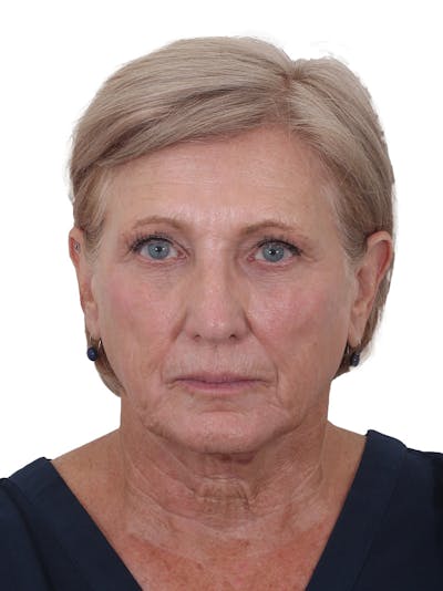 Fat Transfer Before & After Gallery - Patient 321539 - Image 1