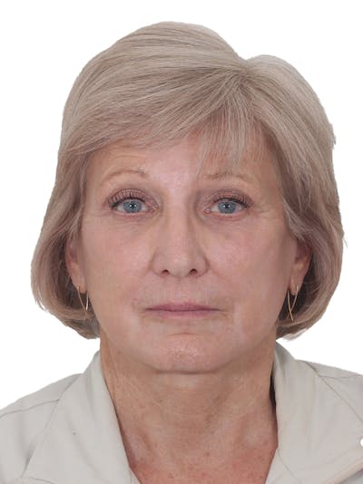 Laser Treatment Before & After Gallery - Patient 323307 - Image 2
