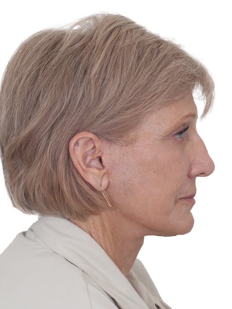 Fat Transfer Before & After Gallery - Patient 321539 - Image 6
