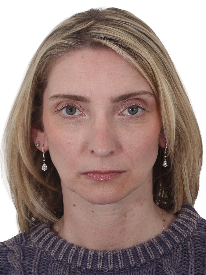 Rhinoplasty Before & After Gallery - Patient 177144 - Image 5