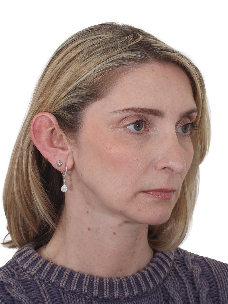 Rhinoplasty Before & After Gallery - Patient 177144 - Image 3