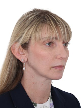 Rhinoplasty Before & After Gallery - Patient 177144 - Image 4