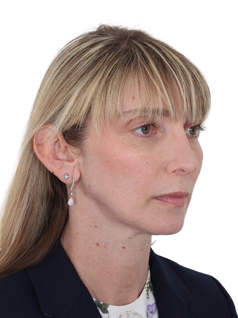 Rhinoplasty Before & After Gallery - Patient 177144 - Image 4