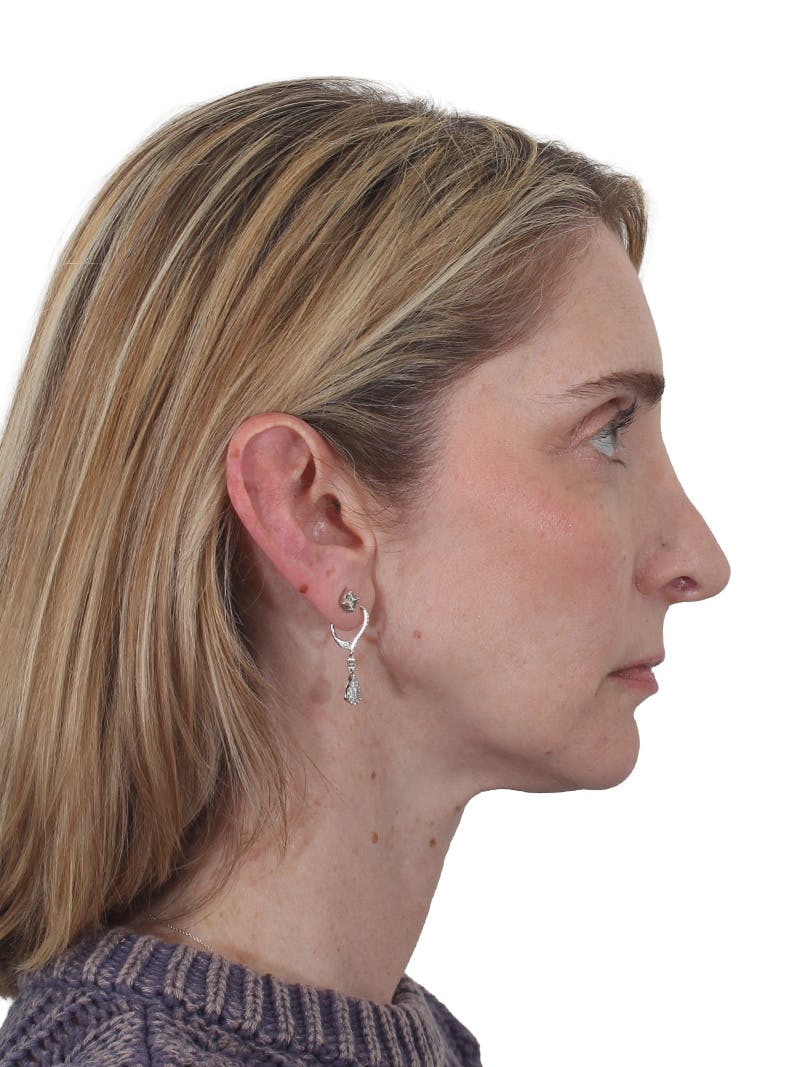 Rhinoplasty Before & After Gallery - Patient 177144 - Image 1