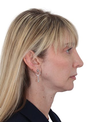 Rhinoplasty Before & After Gallery - Patient 177144 - Image 2