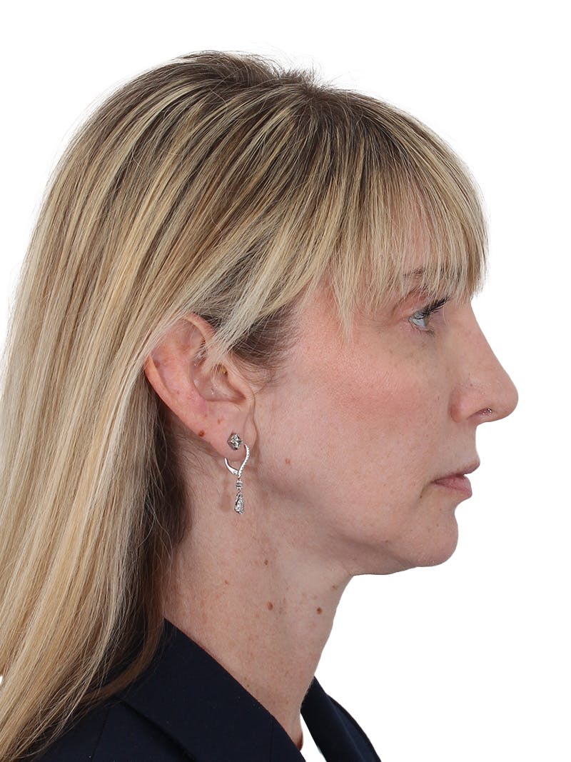 Rhinoplasty Before & After Gallery - Patient 177144 - Image 2