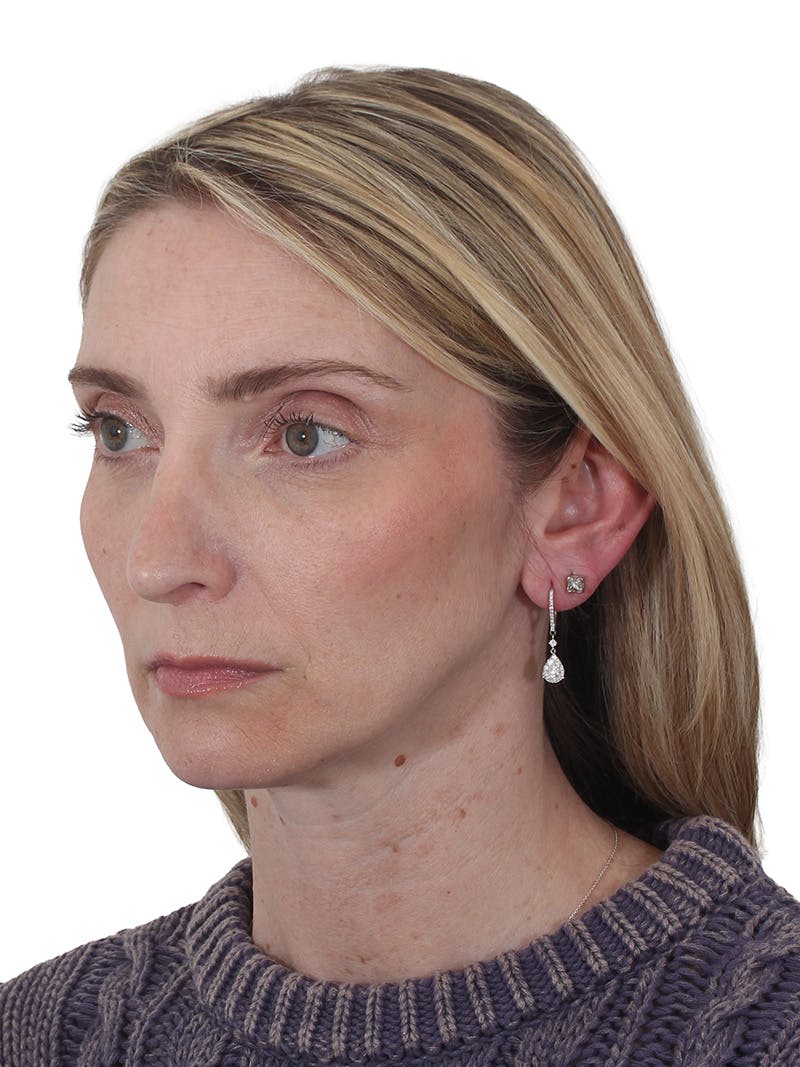 Rhinoplasty Before & After Gallery - Patient 177144 - Image 7
