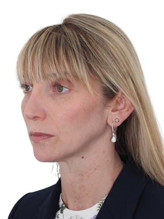Rhinoplasty Before & After Gallery - Patient 177144 - Image 8