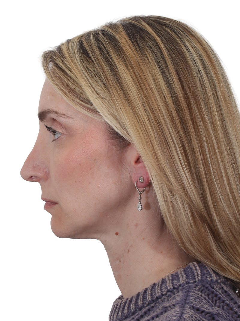 Rhinoplasty Before & After Gallery - Patient 177144 - Image 9