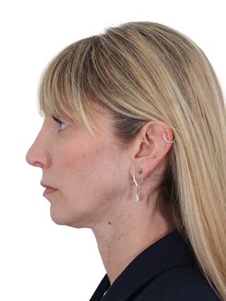 Rhinoplasty Before & After Gallery - Patient 177144 - Image 10