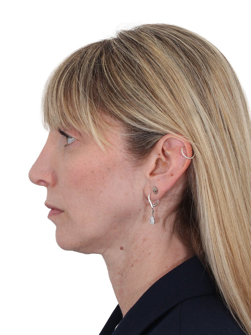 Rhinoplasty Before & After Gallery - Patient 177144 - Image 10