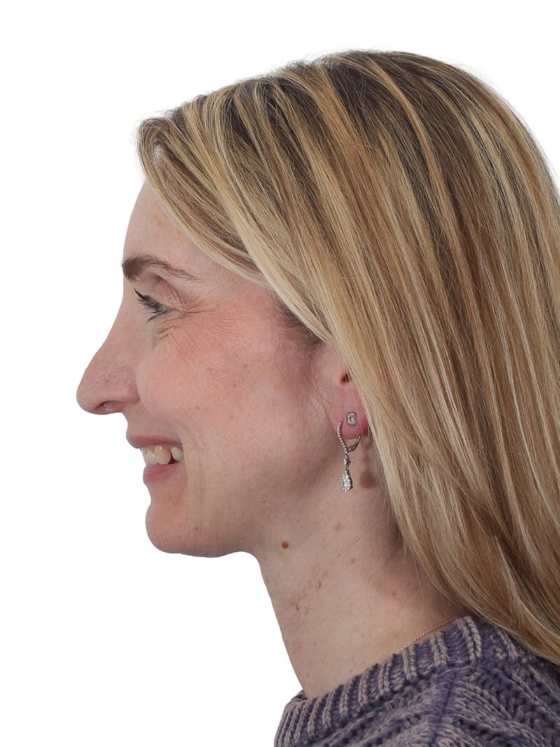 Rhinoplasty Before & After Gallery - Patient 177144 - Image 11