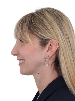 Rhinoplasty Before & After Gallery - Patient 177144 - Image 12