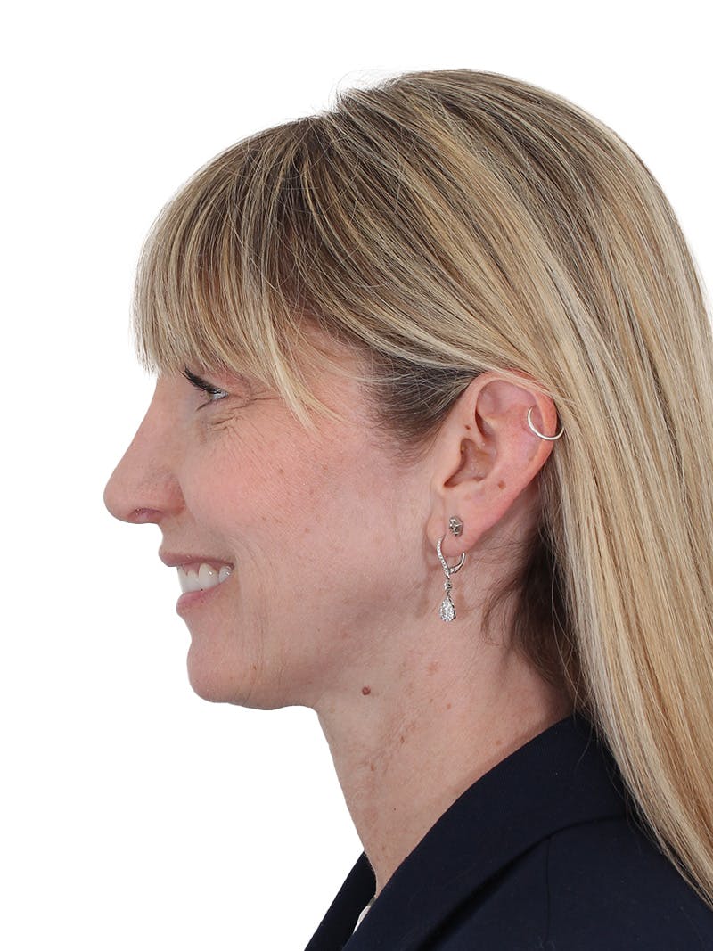 Rhinoplasty Before & After Gallery - Patient 177144 - Image 12
