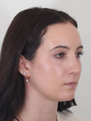 Rhinoplasty Before & After Gallery - Patient 260600 - Image 4