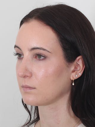 Rhinoplasty Before & After Gallery - Patient 260600 - Image 8