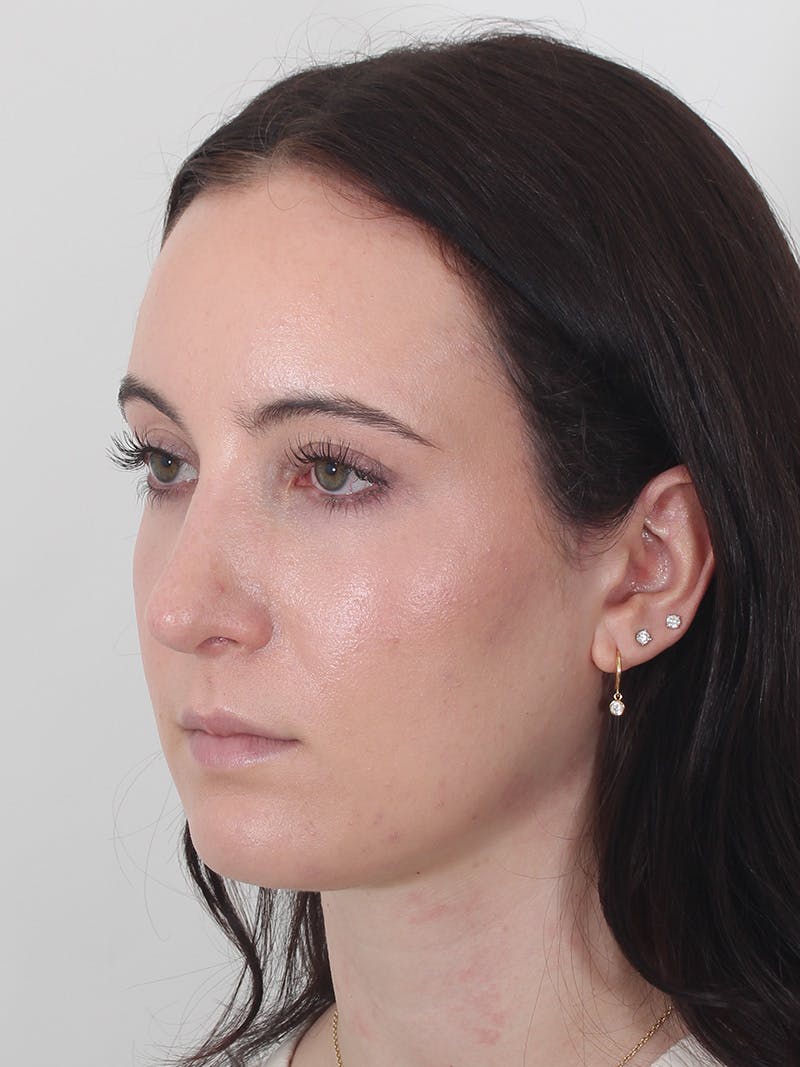 Rhinoplasty Before & After Gallery - Patient 260600 - Image 8