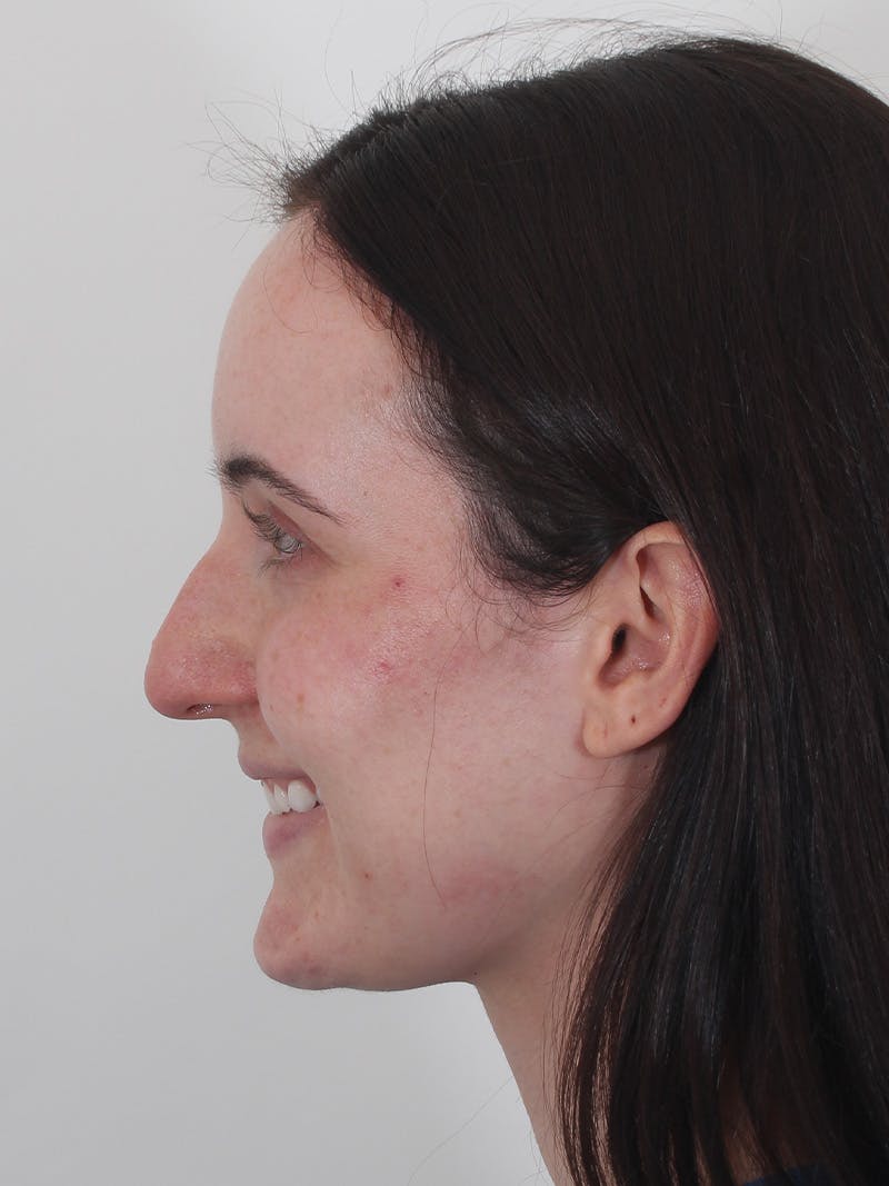 Rhinoplasty Before & After Gallery - Patient 260600 - Image 11