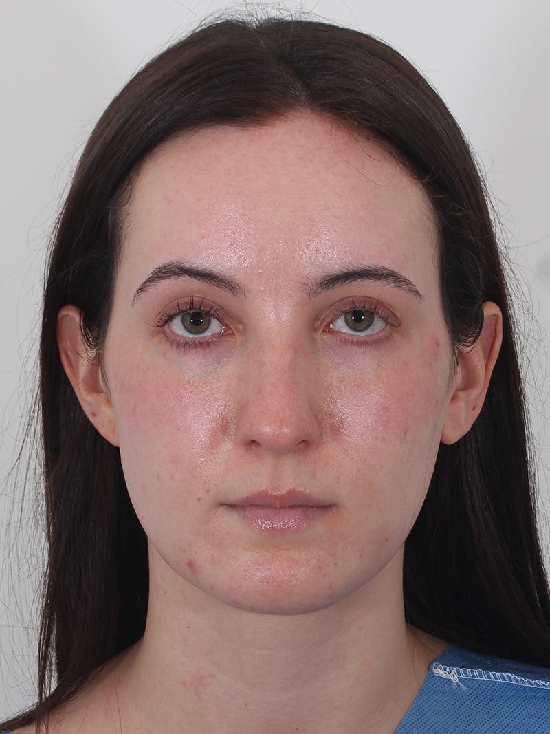 Rhinoplasty Before & After Gallery - Patient 260600 - Image 5