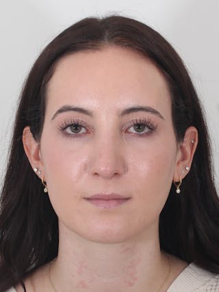 Rhinoplasty Before & After Gallery - Patient 260600 - Image 6