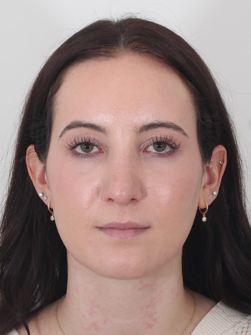 Rhinoplasty Before & After Gallery - Patient 260600 - Image 6