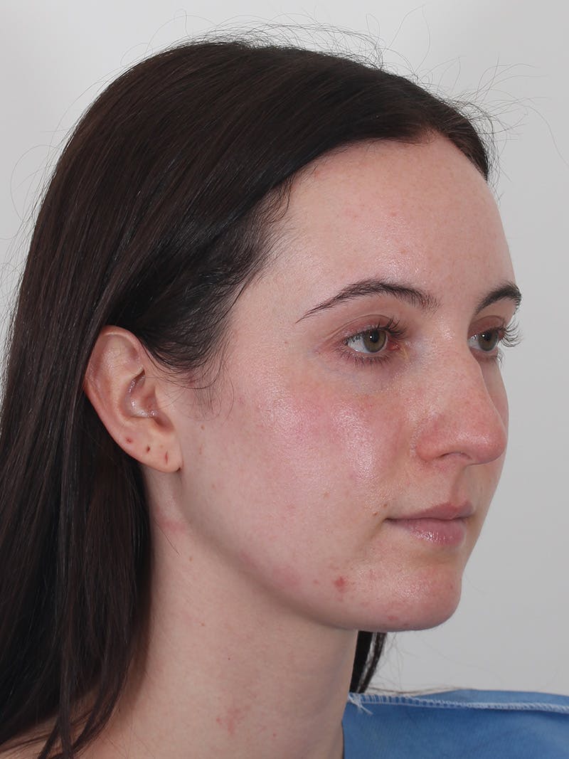 Rhinoplasty Before & After Gallery - Patient 260600 - Image 3