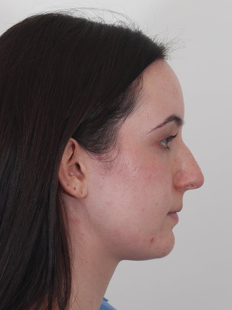 Rhinoplasty Before & After Gallery - Patient 260600 - Image 1