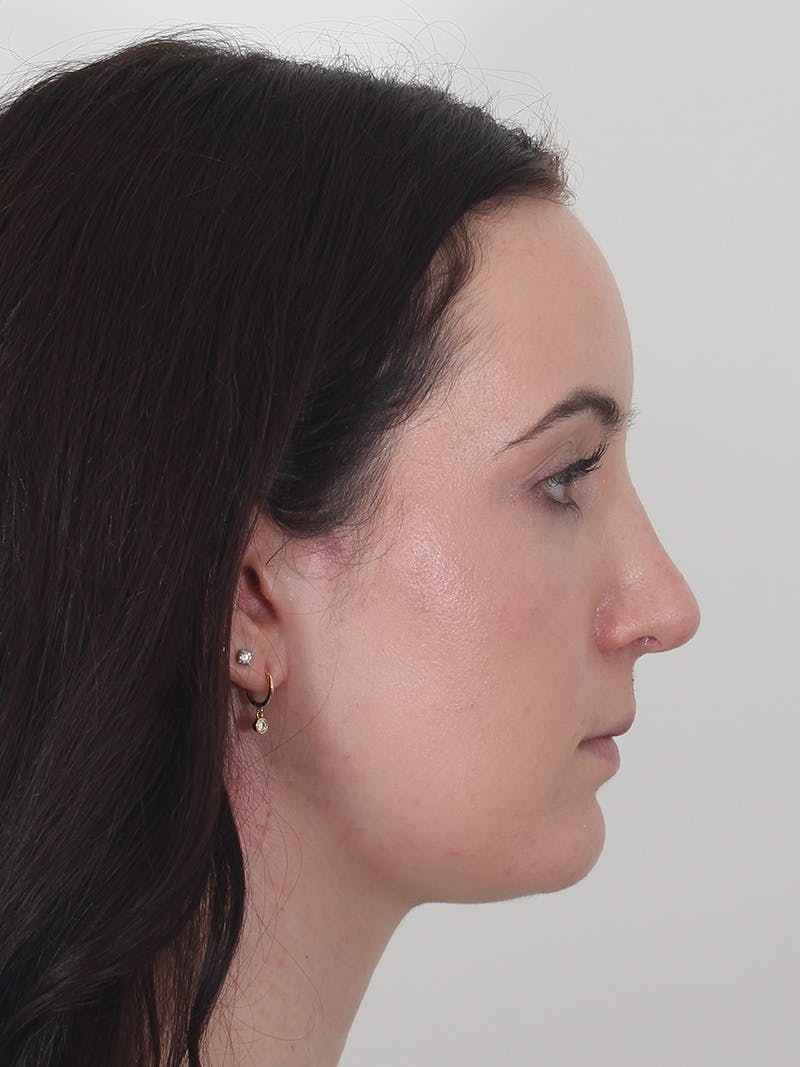 Rhinoplasty Before & After Gallery - Patient 260600 - Image 2