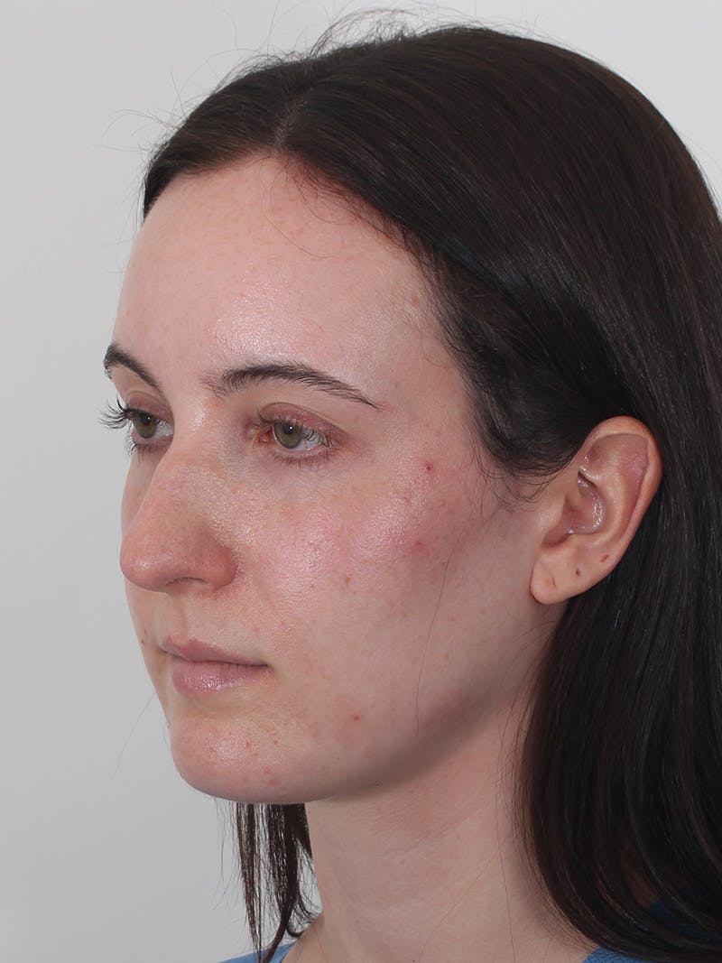Rhinoplasty Before & After Gallery - Patient 260600 - Image 7