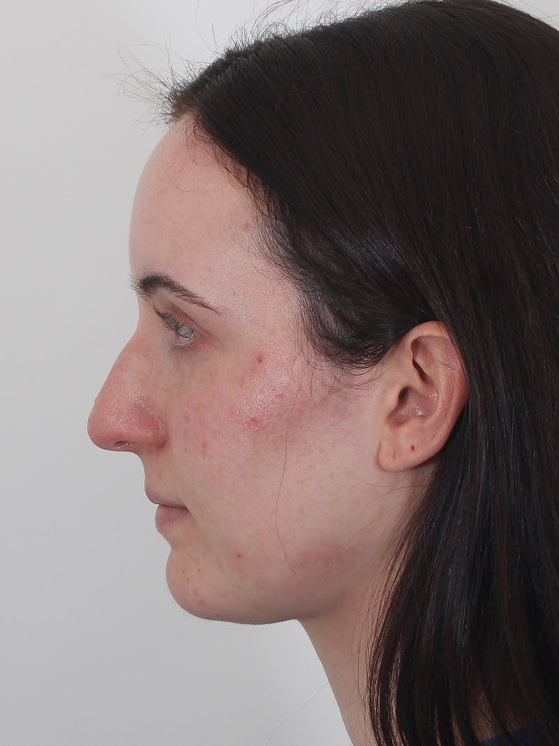 Rhinoplasty Before & After Gallery - Patient 260600 - Image 9