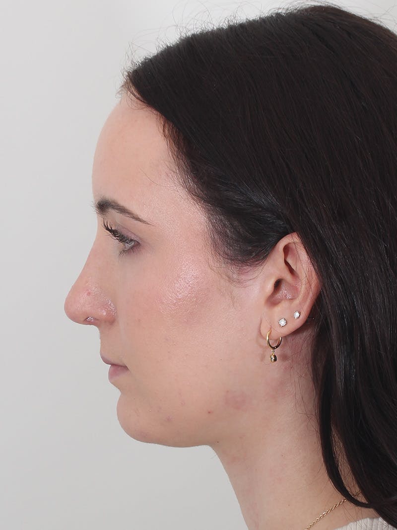 Rhinoplasty Before & After Gallery - Patient 260600 - Image 10