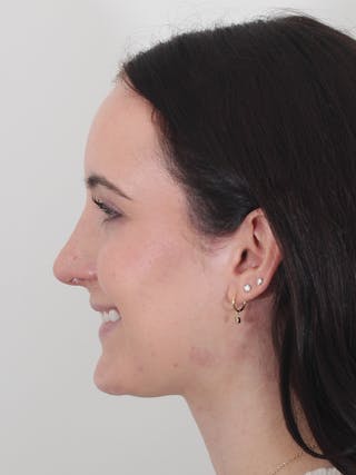 Rhinoplasty Before & After Gallery - Patient 260600 - Image 12