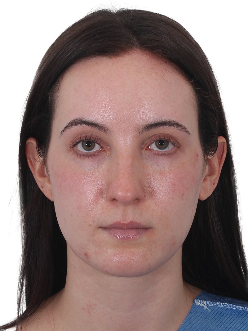 Rhinoplasty Before & After Gallery - Patient 260600 - Image 5