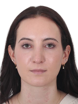 Rhinoplasty Before & After Gallery - Patient 260600 - Image 6