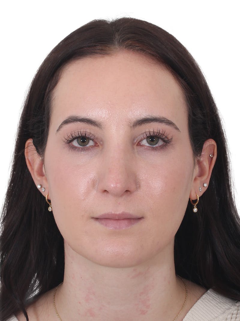 Rhinoplasty Before & After Gallery - Patient 260600 - Image 6